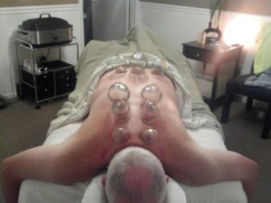 photo of man with glass cups applied to his back